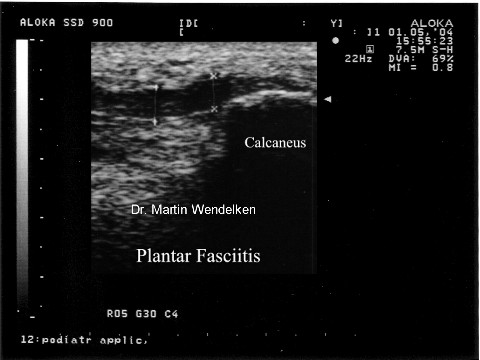 Plantar Fascia